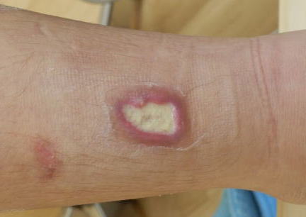 第4度熱傷の原因